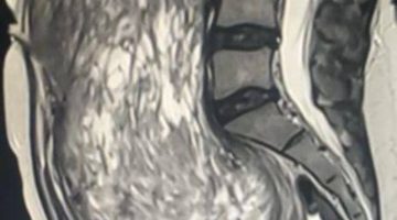 استئصال ورم بحجم «جنين» من ثلاثينيَّة