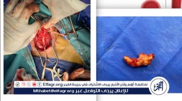 الفريق الطبي بمستشفى السنبلاوين ينجح في إنقاذ حياة مريض يعاني من جلطة بالمخ في الدقهلية
