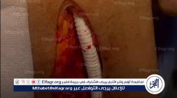 نجاح أول عملية زراعة شريان صناعي من البطن إلى الطرف السفلي بمستشفى السنبلاوين