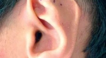 صاحب «الأُذن الخفاشيَّة» وداعًا لـ«التنمُّر المدرسي»