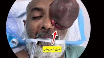 تضخم كبير كاد يستأصل عين مقيم.. وطبيب سعودي ينهي المعاناة